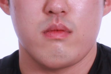부산긴얼굴긴턱교정