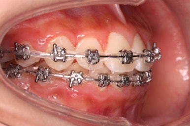 부산비발치교정