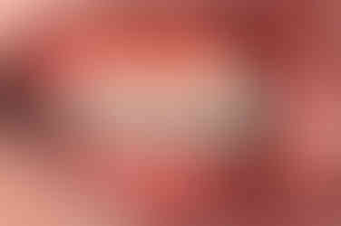 부산비발치교정