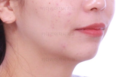 부산사랑니교정