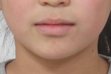 연산동덧니교정