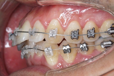 부산교정치과추천