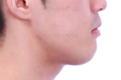 부산긴얼굴긴턱교정