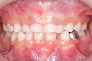 부산어린이치아교정