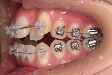 부산비발치교정