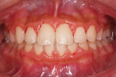 부산비발치교정