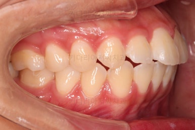 부산연산역치아교정