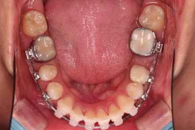 부산사랑니교정