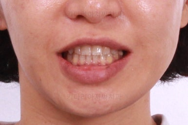부산연산동교정치과