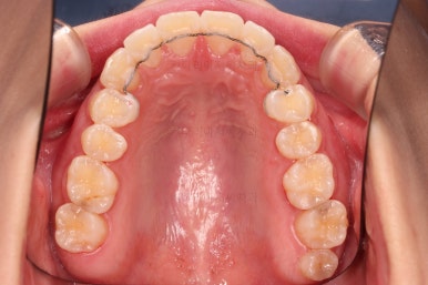 부산앞니부분교정