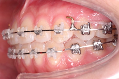 부산치아교정잘하는곳