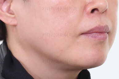 동래임플란트교정