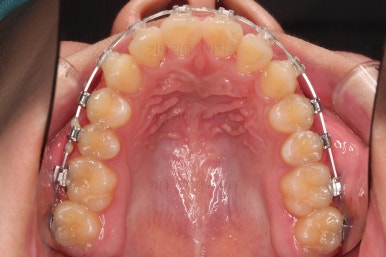 부산비발치교정