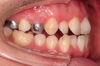 부산긴얼굴긴턱교정