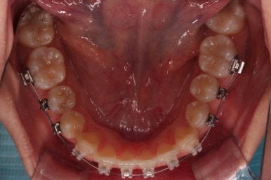 부산치아교정추천