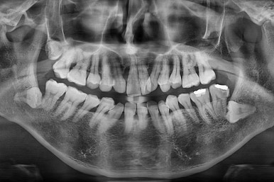 부산구순구개열교정