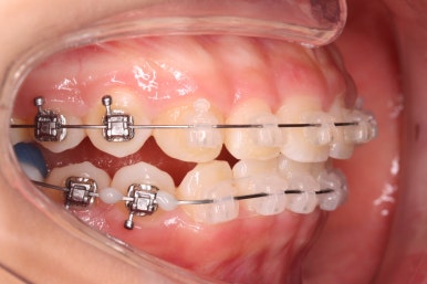 부산치아교정잘하는곳