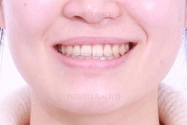 부산치아교정추천