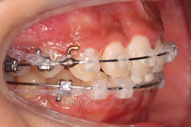 연산동치아교정