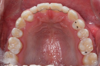 부산왜소치교정