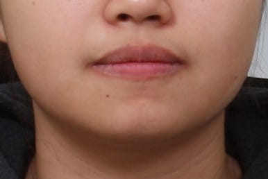 부산부분교정
