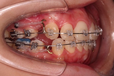 부산클리피씨교정