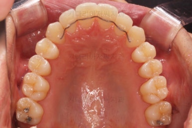 부산비수술교정