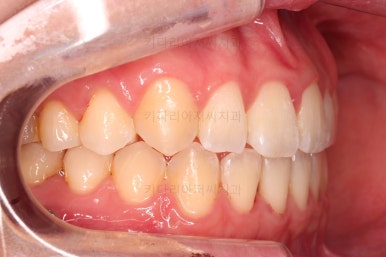 부산치아교정잘하는곳