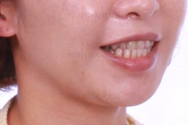 부산연산동교정치과