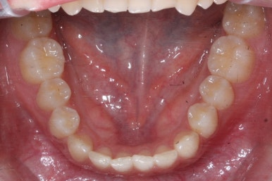 부산매복치아교정