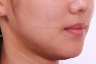부산치아교정잘하는곳