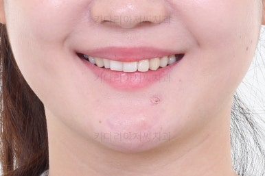 부산인비절라인