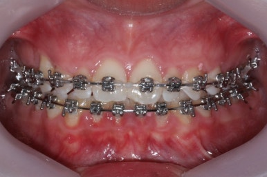 부산왜소치교정