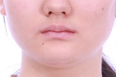 연산동치아교정