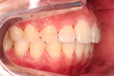 부산연산역치아교정