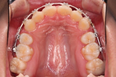 부산클리피씨교정