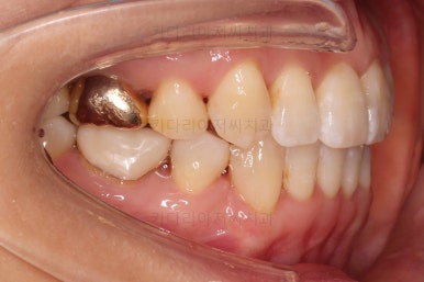 부산인비절라인