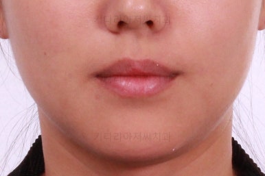 부산치아교정잘하는곳