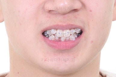 부산청소년치아교정