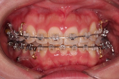 부산비대칭교정