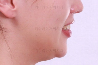 부산비대칭교정