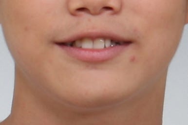 부산왜소치교정