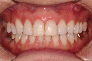 연산동부분교정