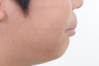 부산어린이돌출입교정