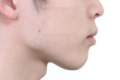 부산돌출입교정