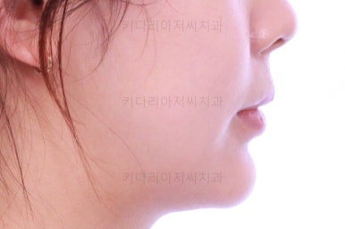 부산안면비대칭