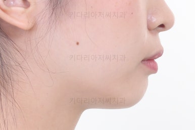 부산돌출입교정