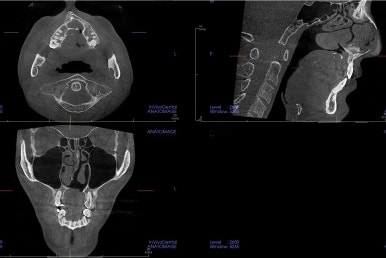 부산구순구개열교정