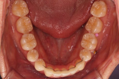 부산비수술교정