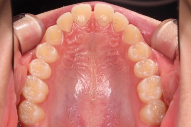 부산앞니벌어짐교정